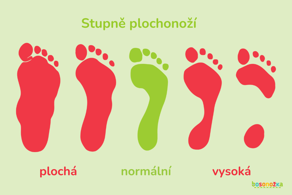 plochá chodidla - stupně plochonoží